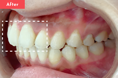 出っ歯治療後 - Oh my teeth マウスピース矯正Basicプラン3ヶ月の症例 Case 04