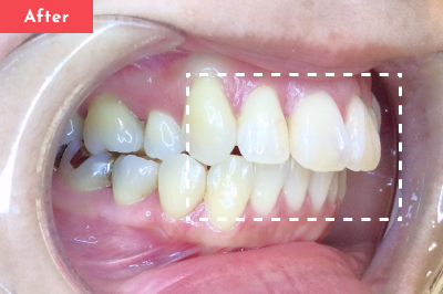 出っ歯治療後 - Oh my teeth マウスピース矯正Basicプラン2ヶ月の症例 Case 05
