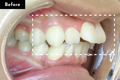 出っ歯治療前 - Oh my teeth マウスピース矯正Basicプラン症例 Case 08