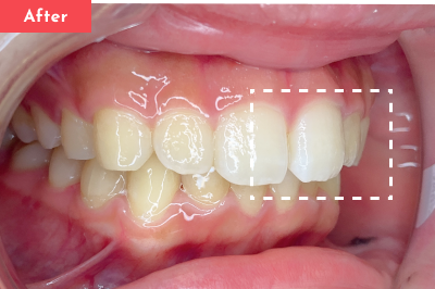 出っ歯治療後 - Oh my teeth マウスピース矯正Basicプラン3ヶ月の症例 Case 13