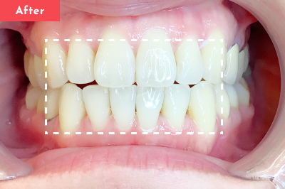 叢生治療後 - Oh my teeth マウスピース矯正Basicプラン6ヶ月の症例 Case 19