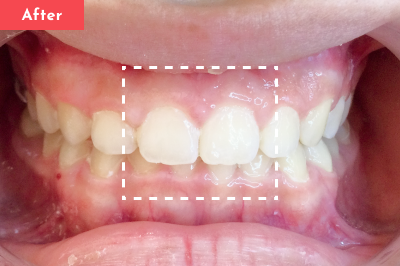 すきっ歯治療後 - Oh my teeth マウスピース矯正Basicプラン3ヶ月の症例 Case 24