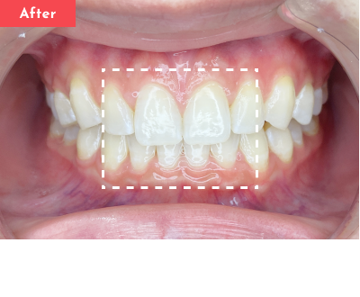 すきっ歯治療後 - Oh my teeth マウスピース矯正Basicプラン2ヶ月の症例 Case 27