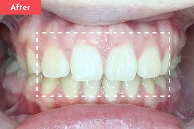 すきっ歯治療後 - Oh my teeth マウスピース矯正Basicプラン4ヶ月の症例 Case 31