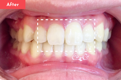すきっ歯治療後 - Oh my teeth マウスピース矯正Basicプラン6ヶ月の症例 Case 32